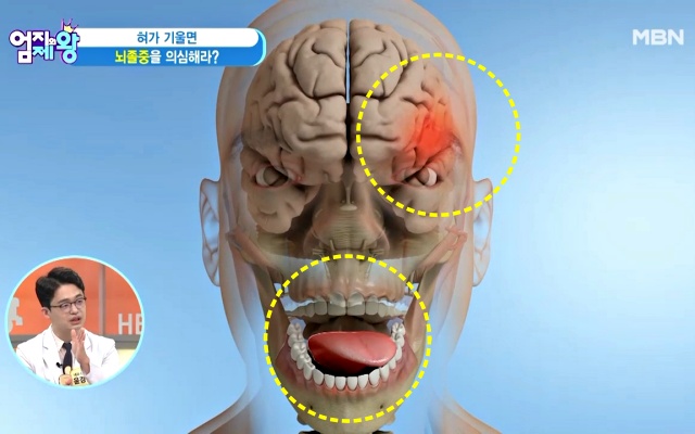 혀로 보는 뇌졸중 초기증상, 혀 기울기, 혀 건강체크, 혀 건강상태, 건강 팁줌 매일꿀정보