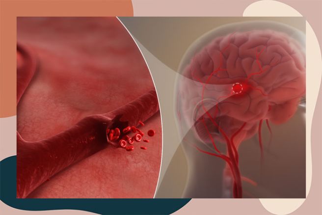 뇌혈관질환 전조증상