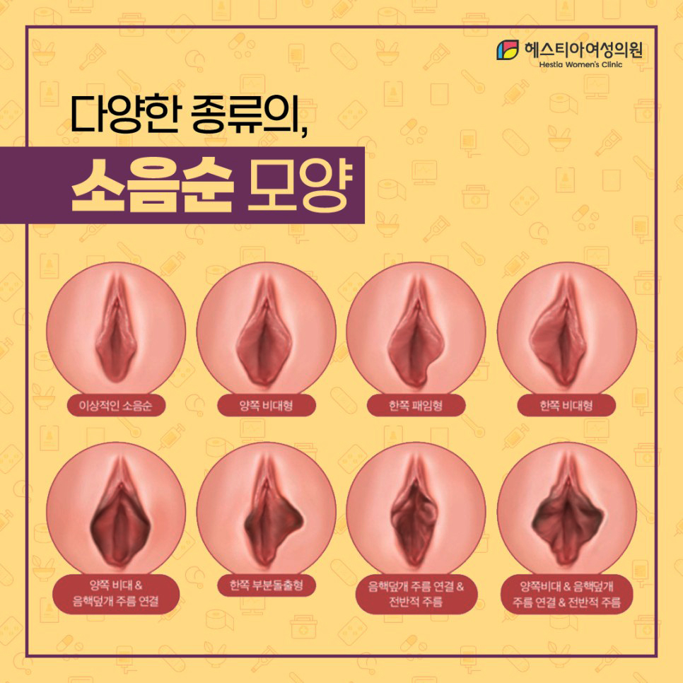 헤스티아여성의원 다양한 종류의 소음순모양