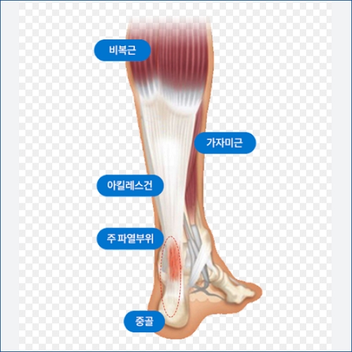 아킬레스 건염