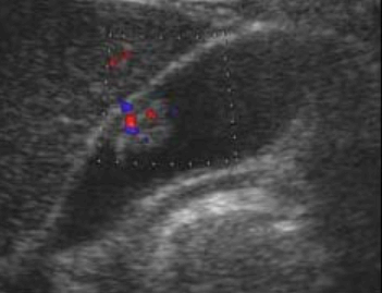 선종성 용종 (adenomatous polyp)