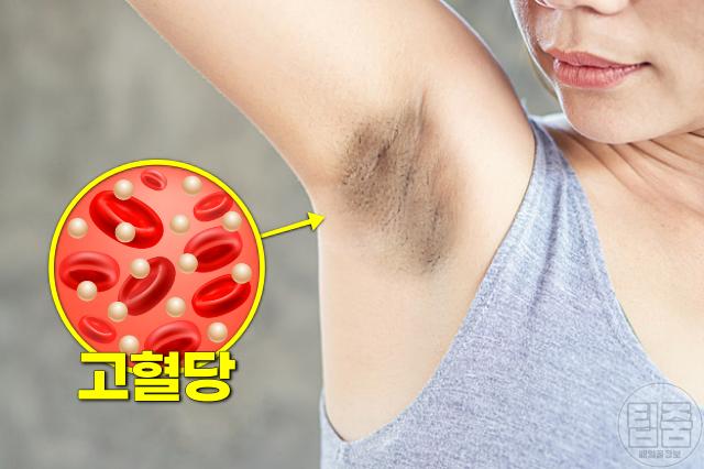 숨은 당뇨병 증상 겨드랑이 착색