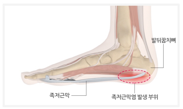 족저 근막염 자가치료