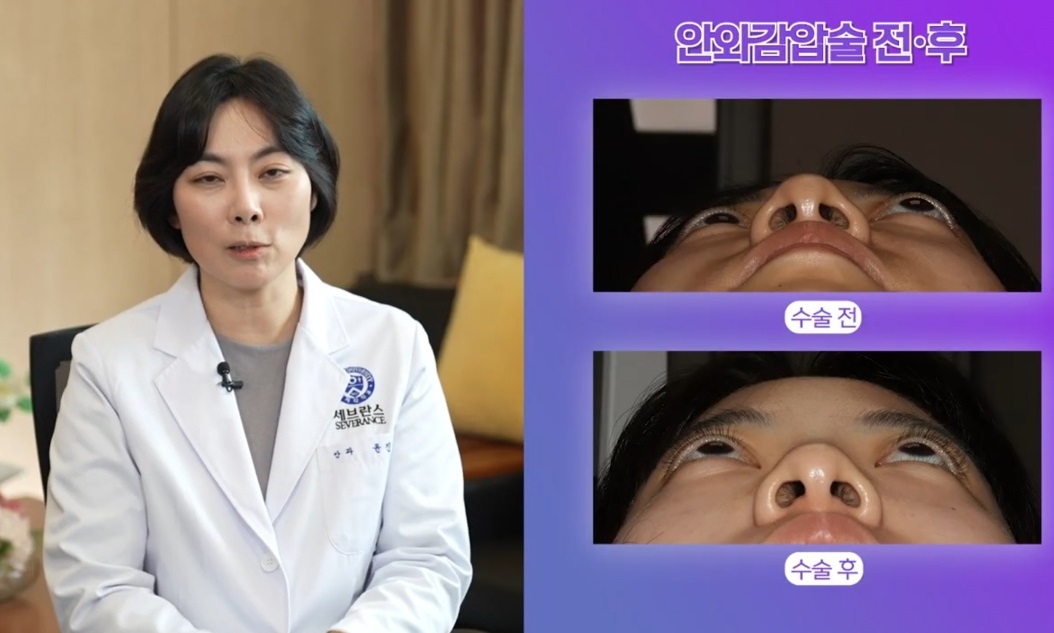 EBS명의-안검하수-윤진숙-교수