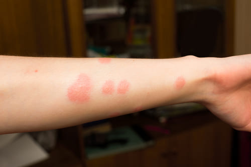 빈대에 물린 자국 사진