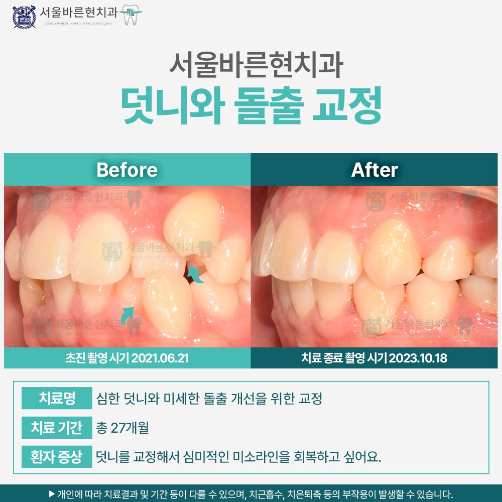 해운대돌출입교정