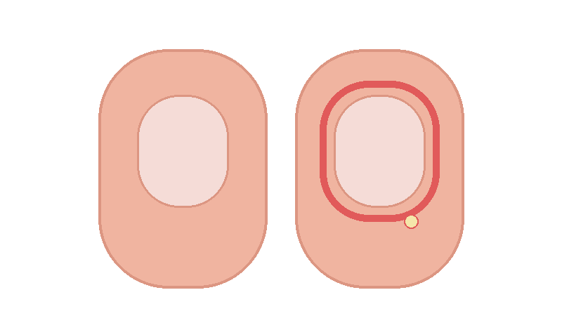 조갑주위염(손톱 주변 염증) 완전 정리: 붓고 아픈 이유부터 치료&middot;재발 방지까지