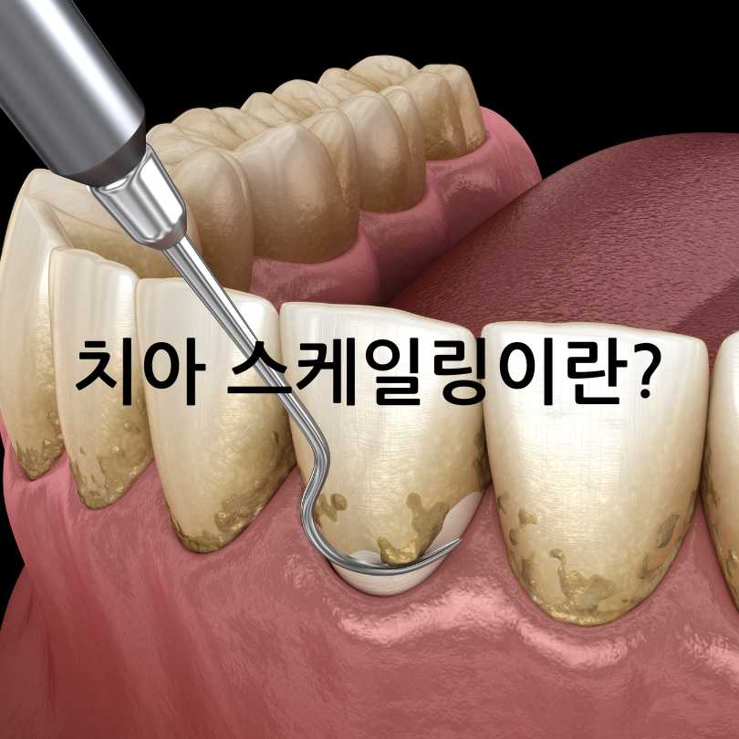 치아 스케일링의 효과와 중요성