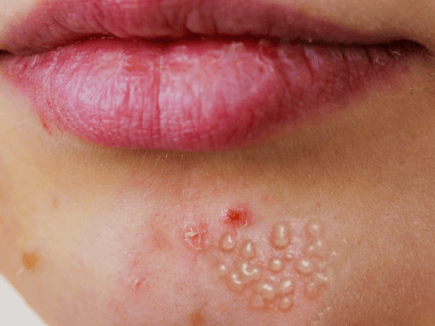 입술물집(헤르페스 1형)