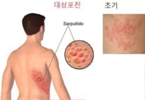 대상포진 초기 발생 부위