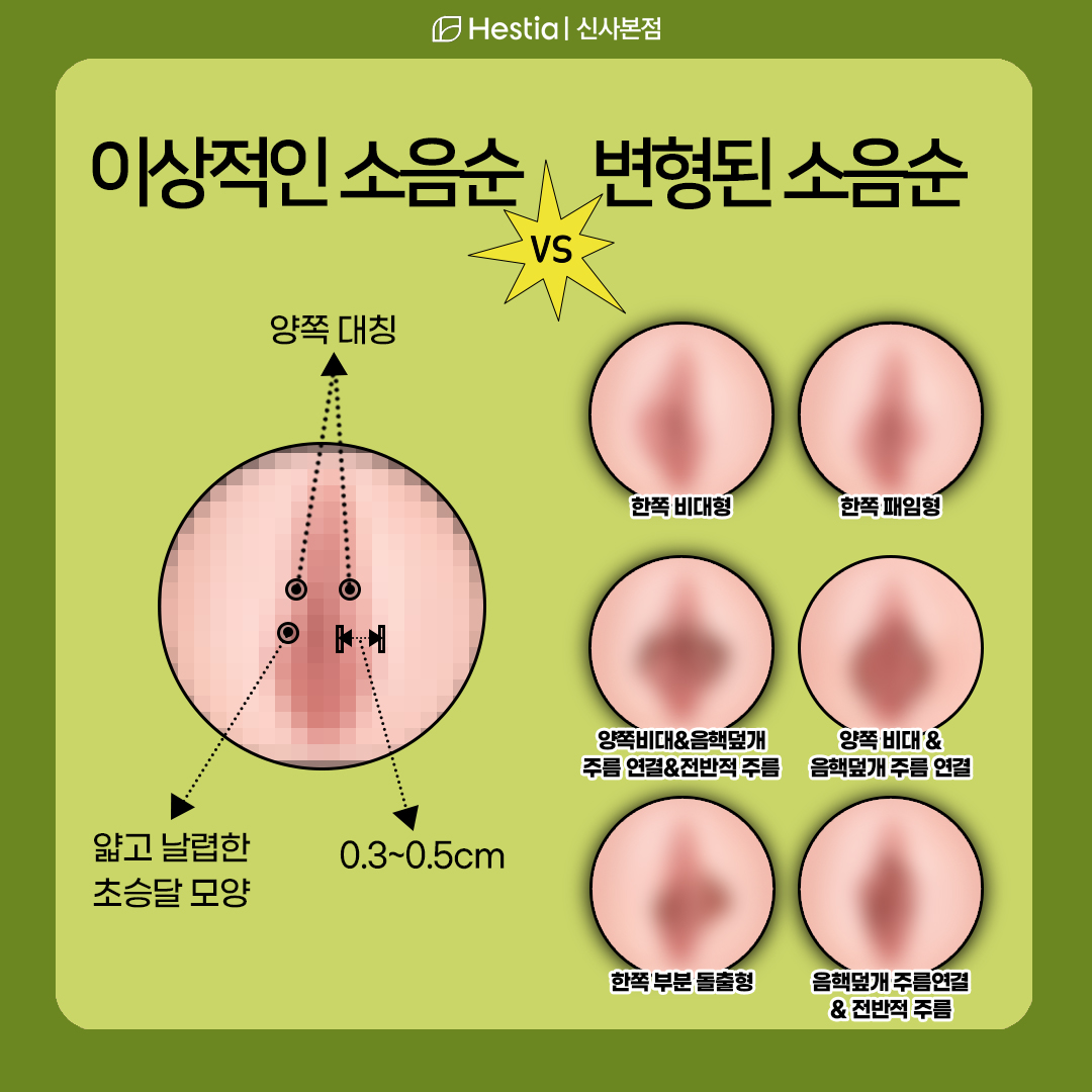내 소음순도 변형된걸까?