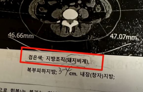 국내 한 병원에서 환자의 지방조직을 '돼지비계'라고 표현한 의사의 언행이 알려졌다. 사진은 여성 A씨가 국내 한 병원에서 촬영한 CT 검사 결과지. [사진=JTBC 사건반장 캡처]