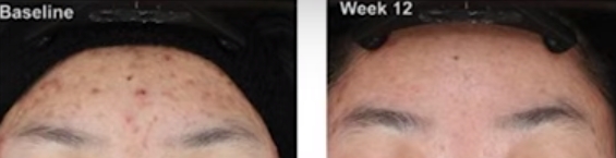 아클리프-크림으로-여드름-없애는-방법