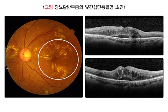 당뇨망막병증