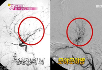 모야모야병 증상 원인 치료방법 관리