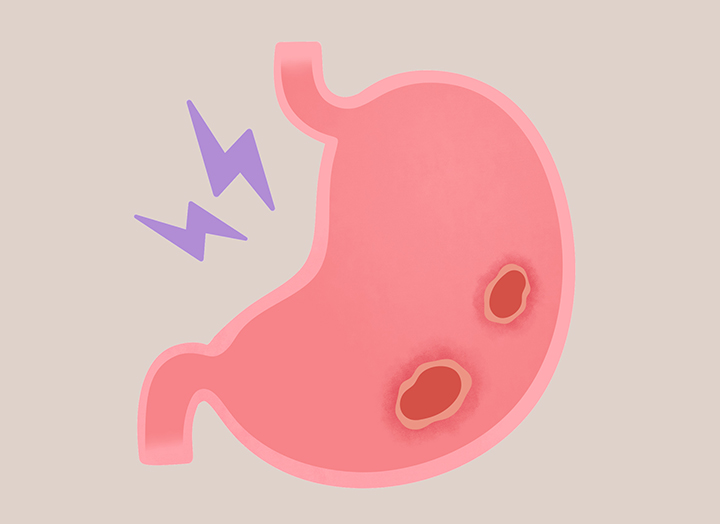 만성위궤양의-모습