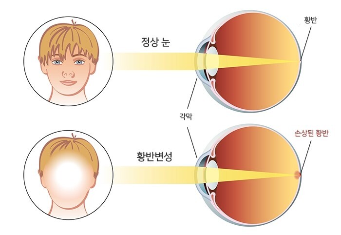 정상눈과 황반변성 비교