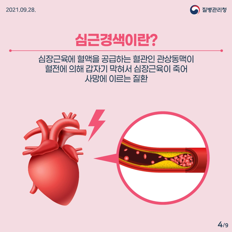 심근경색