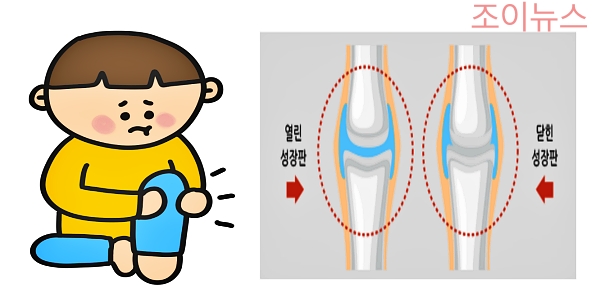 성장판이 닫히는 시기는?