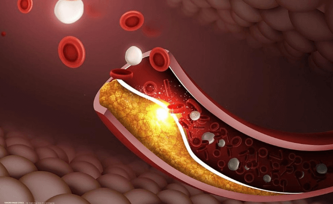고지혈증 관련 사진