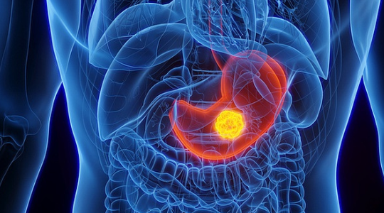 위암 원인 분석 (헬리코박터균, 흡연, 짠 음식)