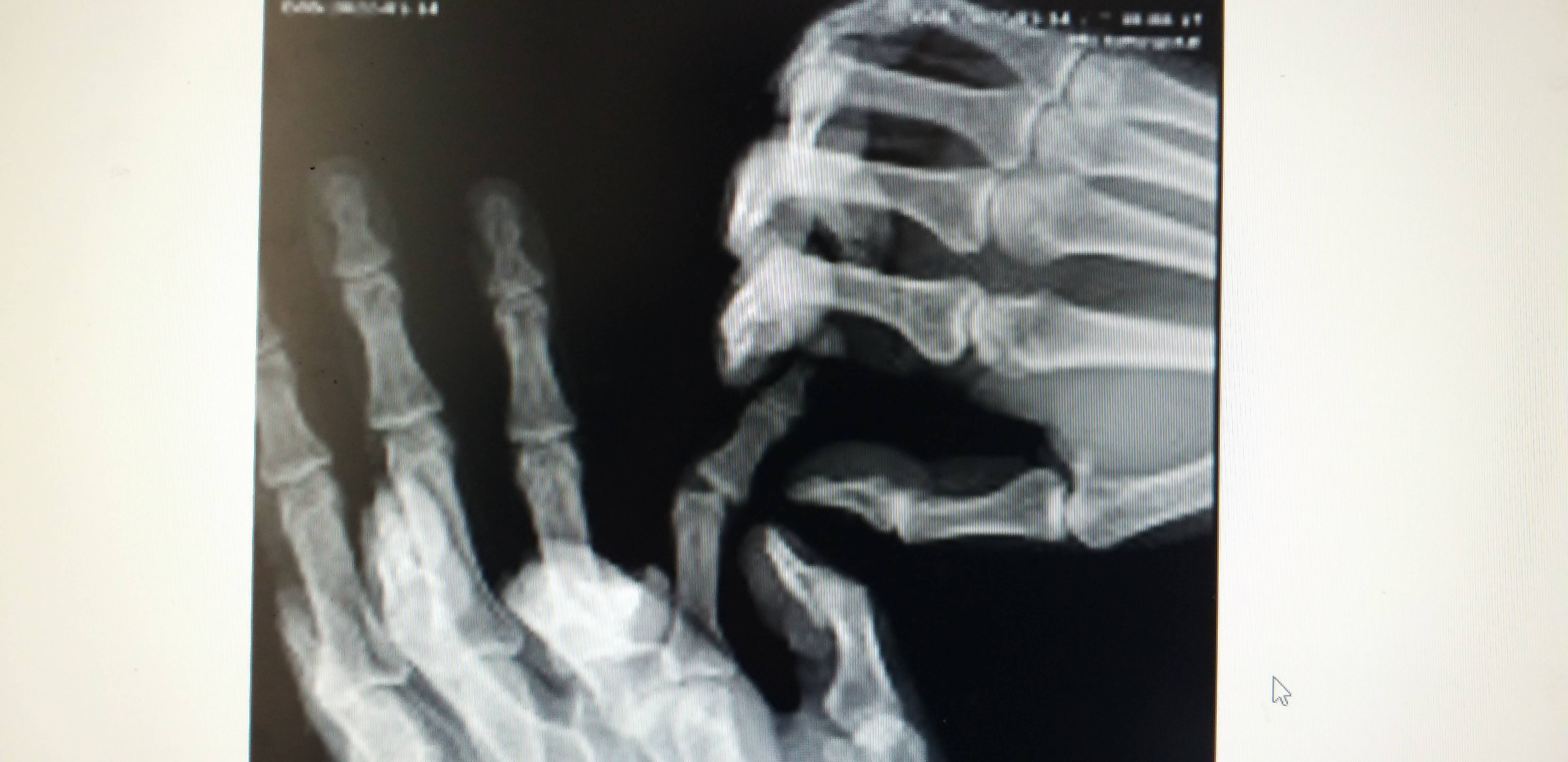 인대파열여부확인사진