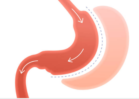 위암 초기증상, 수술비용, 수술후 회복기간 총정리 (2024ver)