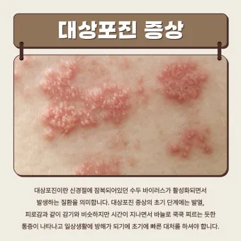 경기도 대상포진 무료접종 연령 기준 정리로 안내_12