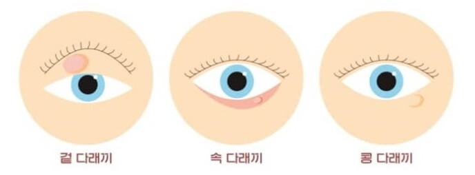 다래끼 종류