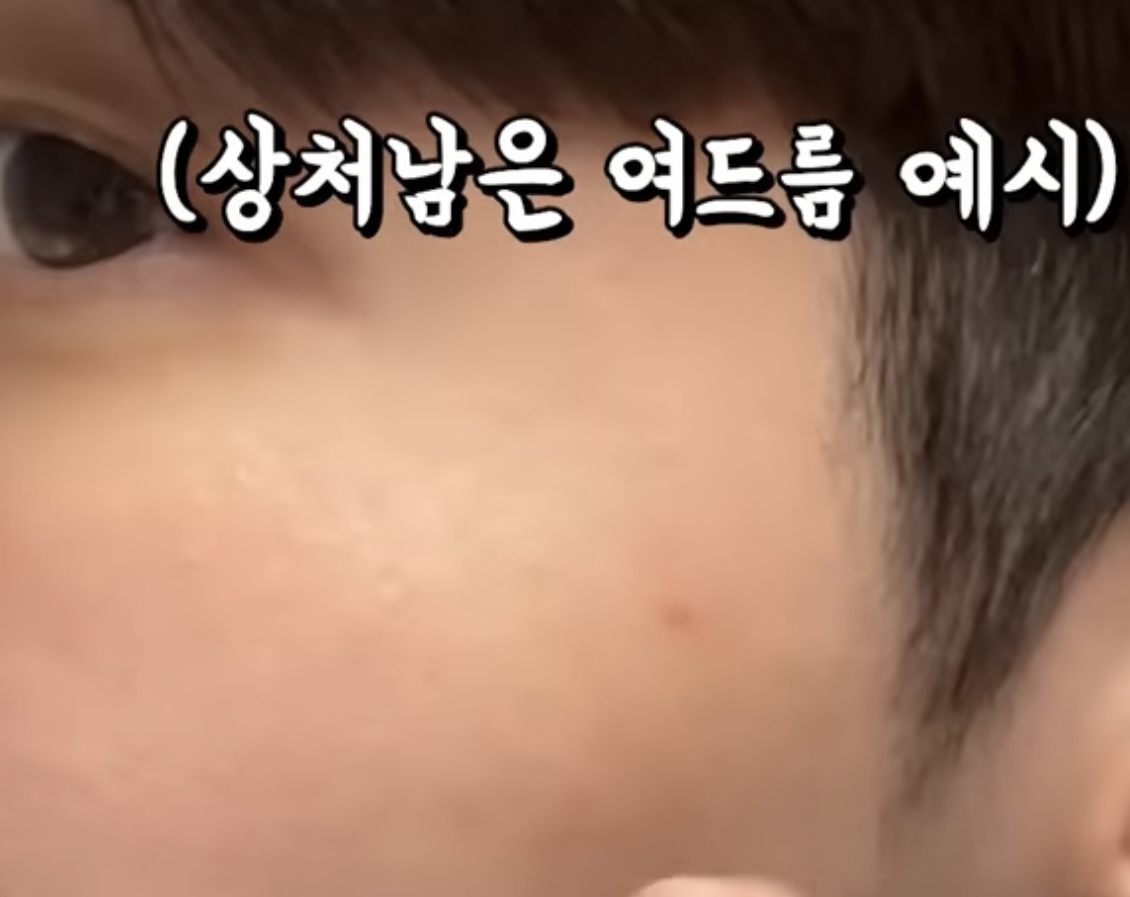흉터 없이 여드름 짜는 방법