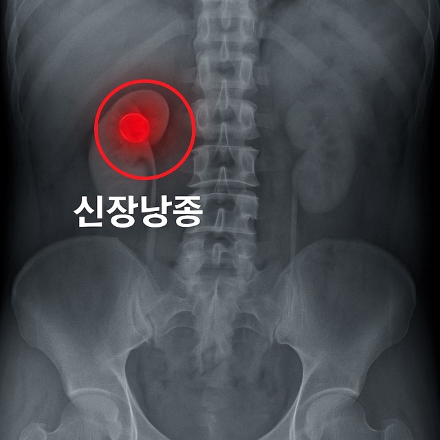 신장낭종 위치를 붉은 원과 글자로 표시한 엑스레이 이미지(출처: 자체제작)