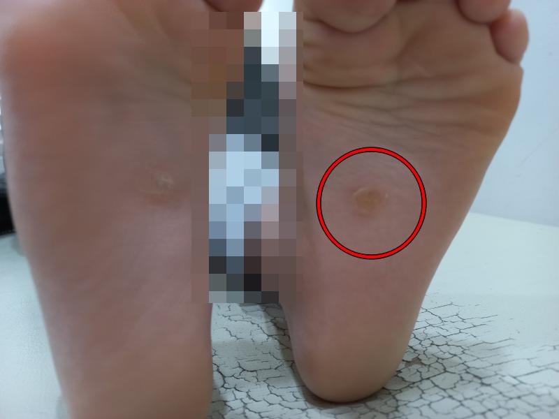 굳은살 냉동치료 4~5주차