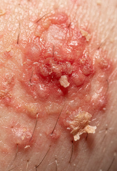 간질환과 피부병 증상의 관계