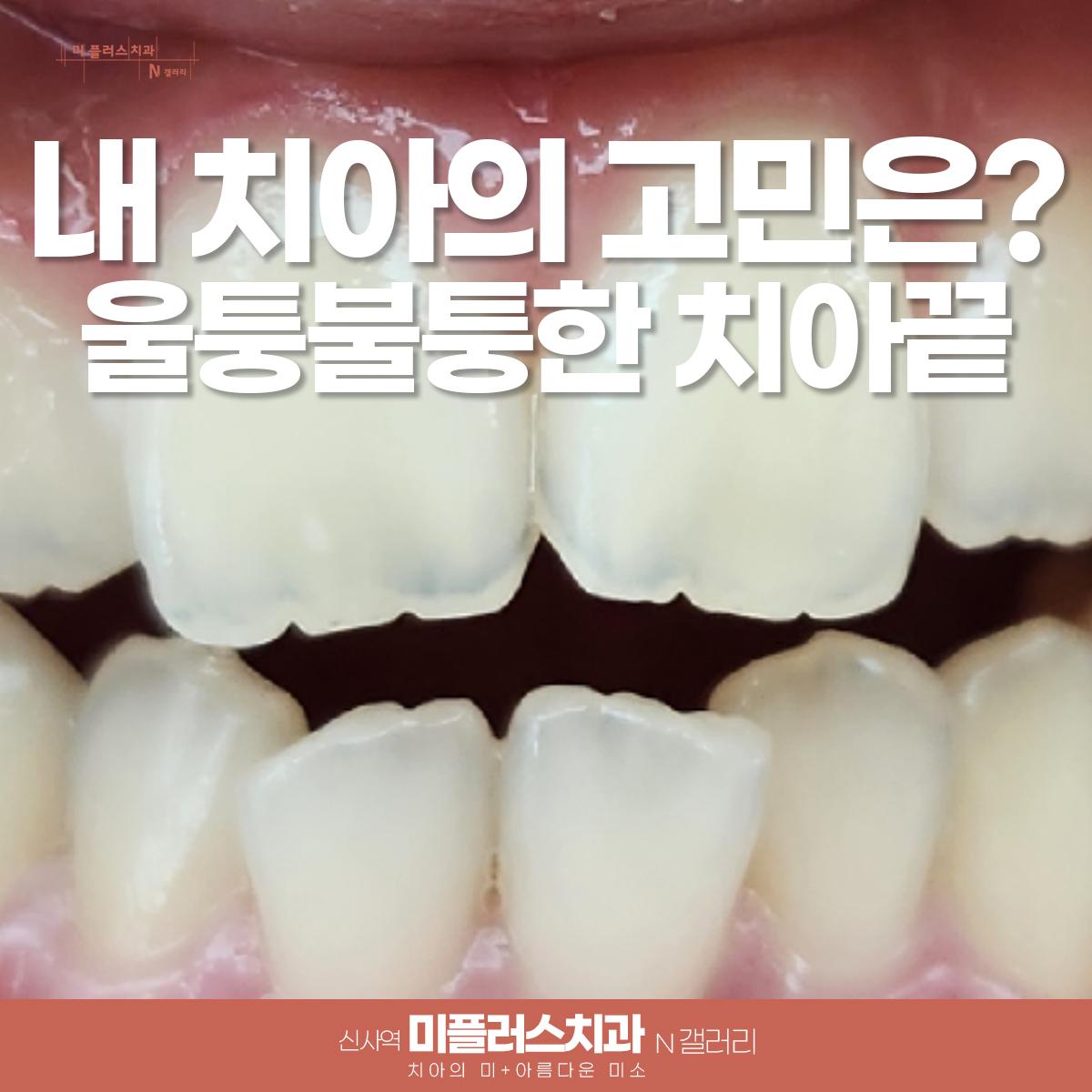 앞니 울퉁불퉁 에나멜플라스티 전