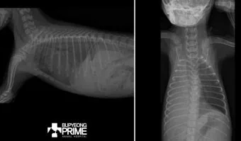 폐에 물이 차는 원인 증상 물참 관리 포인트에 대한 건강정보_13