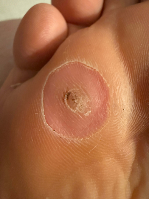 족저사마귀-치료-사진