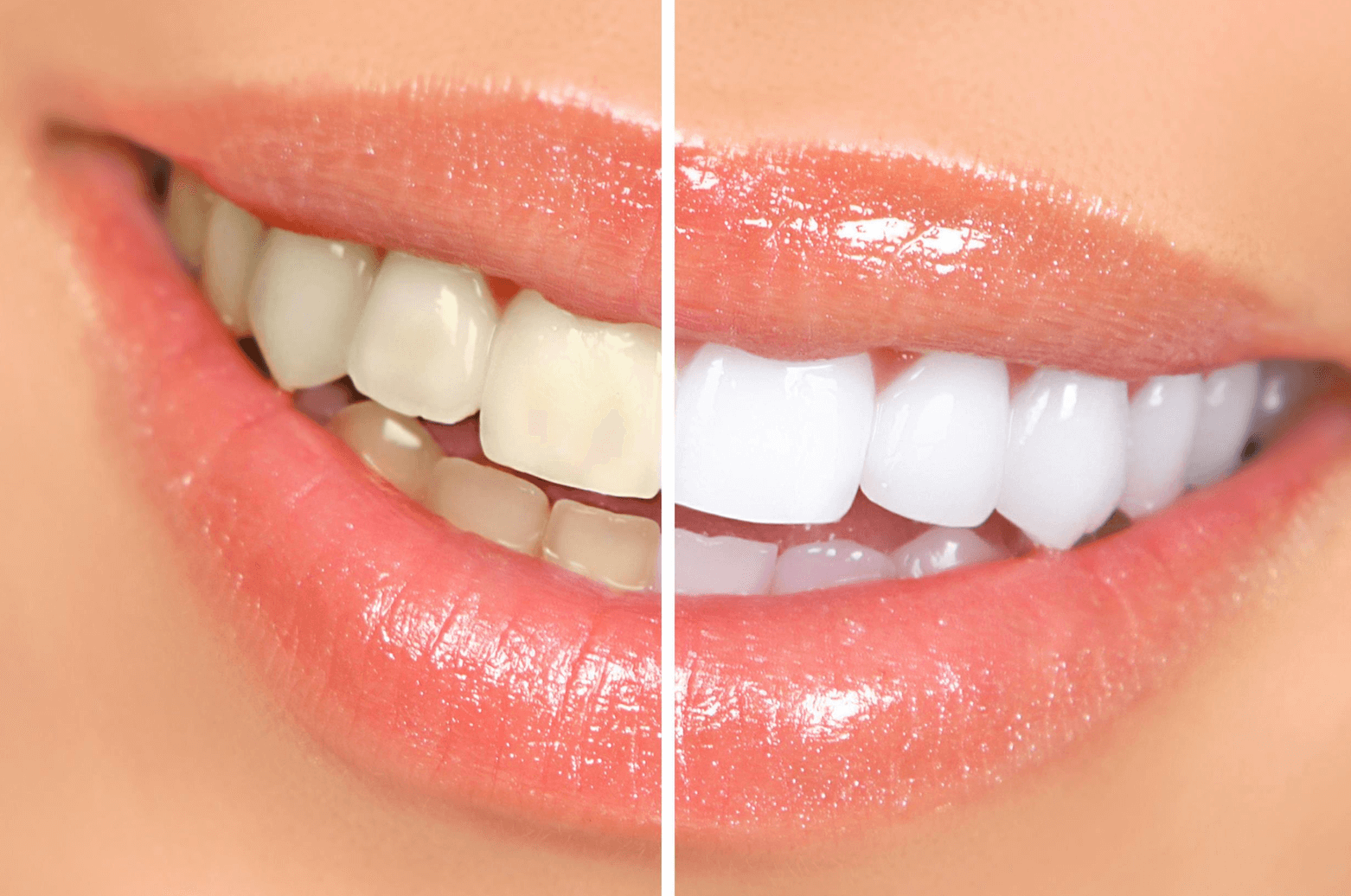 치아 미백 차이