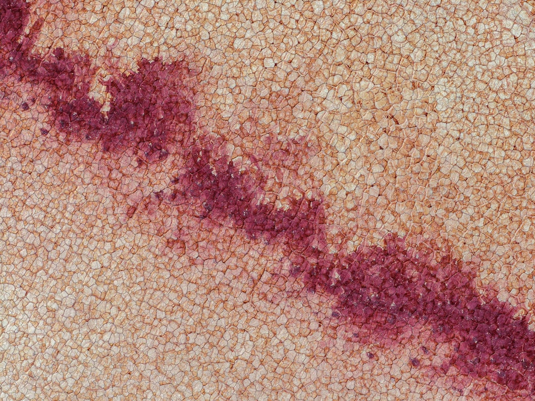 Measles