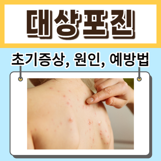 대상포진-초기증상-원인-예방법