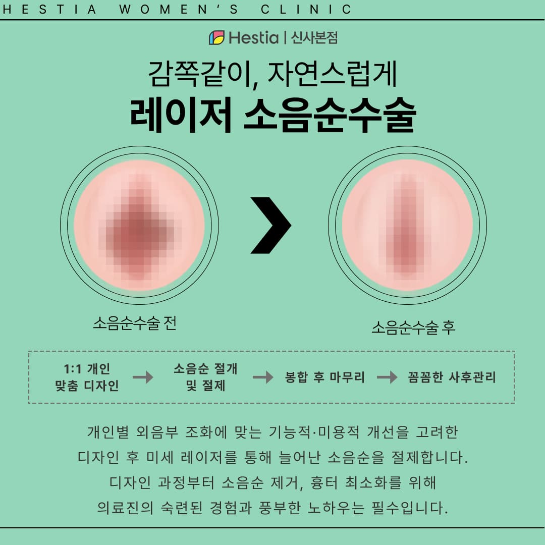 소음순성형수술이란?