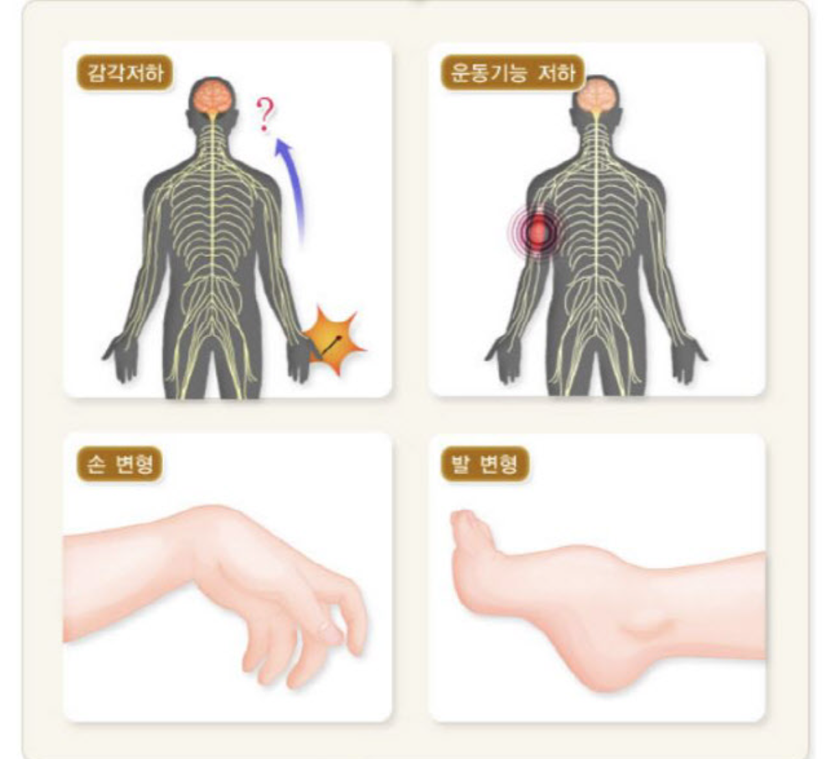 삼성가 이부진 사장 걸음걸이와 샤르코 마리 투스 유전병 팩트체크