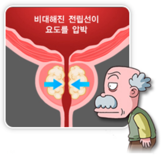전립선비대증