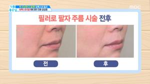 미간 주름 필러