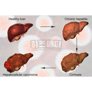 ALT수치가 높으면