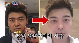 눈밑지방재배치