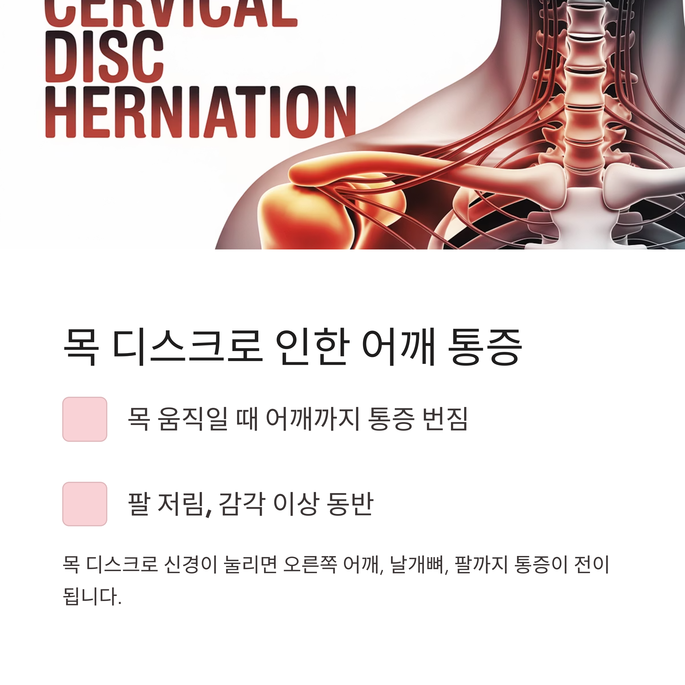 목 디스크로 인해 발생하는 어깨 통증과 연관 증상에 대한 해부학적 이미지 및 설명