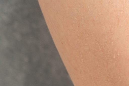 초기 건선 증상