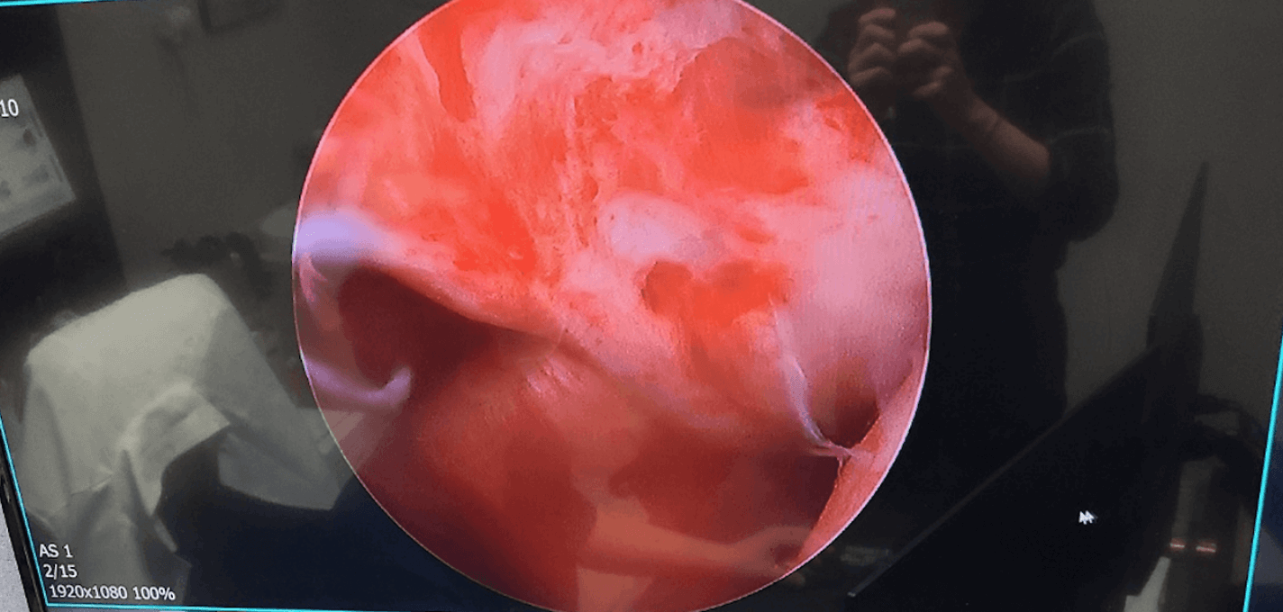 어깨충돌증후군