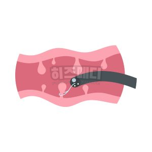 분변 잠혈검사 양성