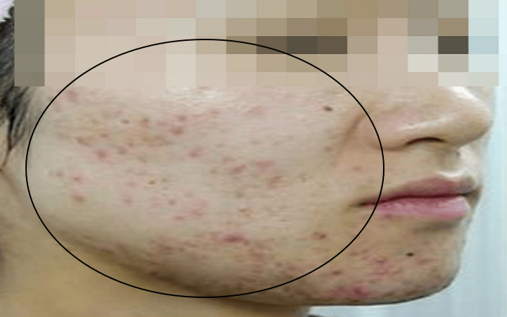 프락셀 레이저 시술 전 얼굴의 상태